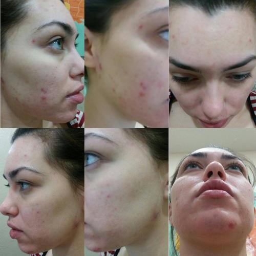 Accutane 40 Mg To 60 Mg